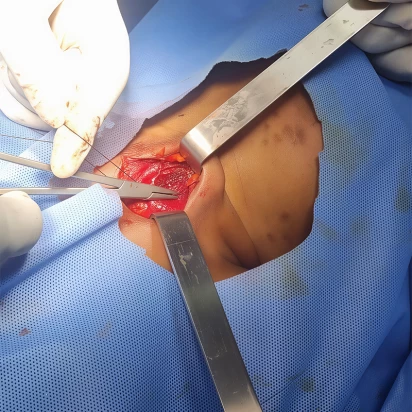 Cervicofacial Surgery